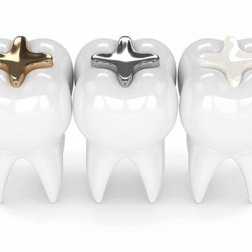 Why Are Dental Fillings Necessary?